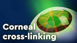 Corneal Collagen Crosslinking and Keratoconus Treatment [upl. by Alexio]