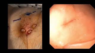 How to perform direct percutaneous gastrostomy with Tfastener gastropexy using endoscopic guidance [upl. by Michelle880]