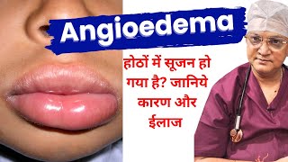 मेरे होंठ सूज गए Angioedema  Swelling of lips and face ANGIOEDEMA Causes Symptoms and Treatment [upl. by Veronika93]