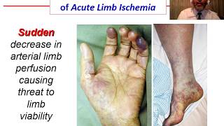 Acute Ischemia  OVERVIEW [upl. by Ahsini]