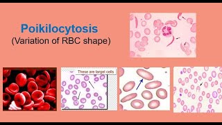 Poikilocytosis Variation of RBC shape [upl. by Eednarb706]