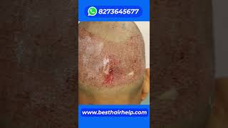 Full Hair Transplant Journey after 6 Month Results fuehairtransplant hairtransplantcostinindia [upl. by Allebara]