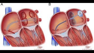 Atrial Fibrillation Ablation Procedure  Pulmonary Vein Isolation Simple Solution [upl. by Esinehc]