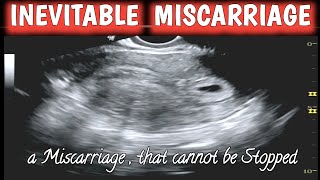 Inevitable Miscarriage  Early Pregnancy Missed Abortion [upl. by Yesima608]