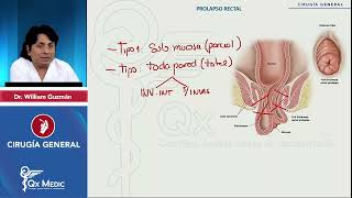 CIRUGÍA GENERAL Patología anorrectal Prolapso rectal mp4 [upl. by Worsham]