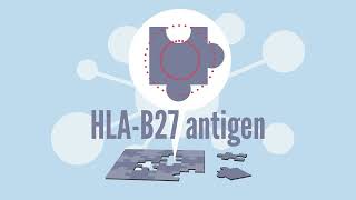 HLA B27 History with Ankylosing Spondylitis [upl. by Nosirb954]