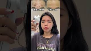 Reduce forehead wrinkles tips forehead wrinkles beautydevice beautyhacks beauty shorts [upl. by Noni]