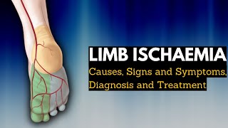 Limb Ischaemia  Causes Signs and Symptoms Diagnosis and Treatment [upl. by Anileuqcaj]