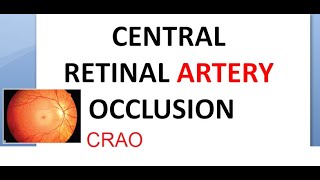 Ophthalmology CRAO Central Retinal Artery Occlusion Cherry Red Spot Cattle Tracking Marcus Gunn [upl. by Melton]