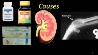 Hypercalcemia  High calcium [upl. by Etnemelc]