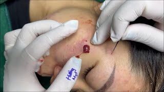 Treating inflamed acne  MrPimples [upl. by Atekan]