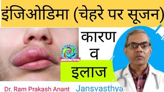 एंजिओडिमा का इलाज Treatment of Angioedema [upl. by Nebur440]