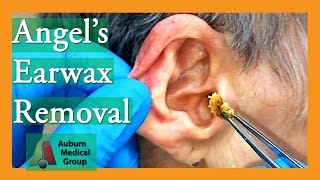 Angels Earwax Removal  Auburn Medical Group [upl. by Yelsnya]