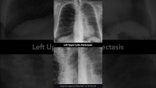 Left Upper Lobe Atelectasis Chest XRay shorts [upl. by Faina341]