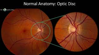 Fundus Photography Interpretation [upl. by Romonda]