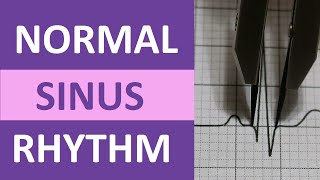 Normal Sinus Rhythm Nursing Made Easy on ECGEKG Heart Interpretation [upl. by Stallworth]