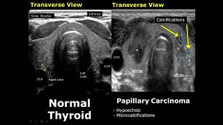 Thyroid Ultrasound Normal Vs Abnormal Image Appearances Comparison  Thyroid Pathologies USG [upl. by Foster]