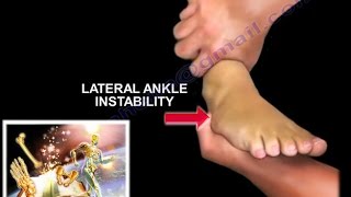 Chronic Lateral Ankle Instability  Everything You Need To Know  Dr Nabil Ebraheim [upl. by Emily]