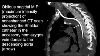 Fehllage Shaldon Katheter akzessorische Vena hemiazygos [upl. by Ahras599]
