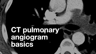 Pulmonary CT Angiogram Basics [upl. by Schaaff]