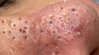 Big Cystic Acne Blackheads Extraction Blackheads amp Milia Whiteheads Removal Pimple Popping  8446 [upl. by Anirdnaxela832]