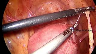 STEP 1  BOWEL AND OMENTAL ADHESIOLYSIS [upl. by Rasec]