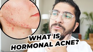 Hormonal Acne Explained [upl. by Rauch489]