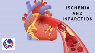 Ischemia and Infarction The difference and Similarities [upl. by Nehepts952]