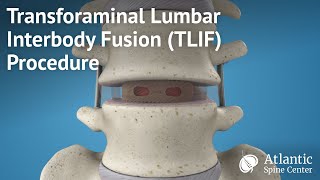 Transforaminal Lumbar Interbody Fusion TLIF Procedure [upl. by Ardnuahs970]