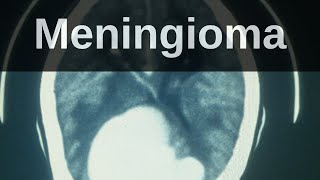 What is a Meningioma Pathology mini tutorial [upl. by Yancey]