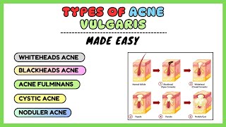 Acne vulgaris types of acne acne types and treatment dermatology made simple [upl. by Paik]