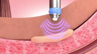 How GAINSWave Solves Peyronies Disease [upl. by Clayborn]