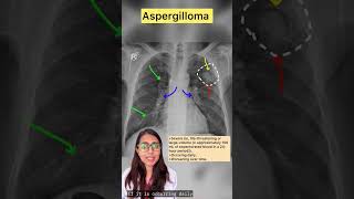 Aspergilloma [upl. by Argela]