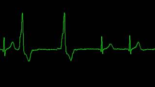 cardiac event monitor with bigeminy arrhythmia [upl. by Noirad530]