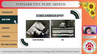 Constrictive pericarditis [upl. by Francklin]