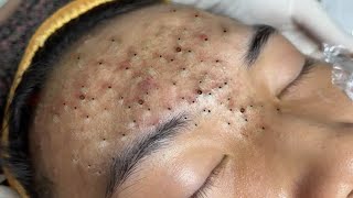 Remove Blackheads For Middleaged Women [upl. by Nert]