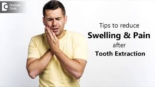 How to manage swelling amp pain post tooth extraction  Dr Chandan Mahesh [upl. by Nej]