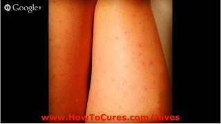 Natural Treatment For Hives  Treatments For Soothing Urticaria Hives  Natural Treatment For Hives [upl. by Otsedom]