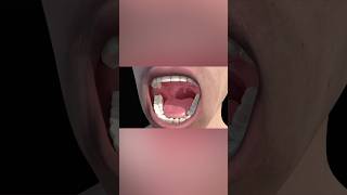 Tonsillitis medicalanimation health [upl. by Ynnep740]