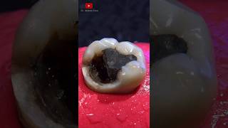 Indirect dental restoration satisfying [upl. by Feodore]