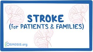 Stroke for patients amp families [upl. by Rovner]