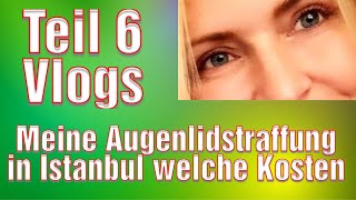 Oberlidstraffung Türkei Erfahrung Lidstraffung in Istanbul Vorher Nachher Augenoperation [upl. by Anibor592]