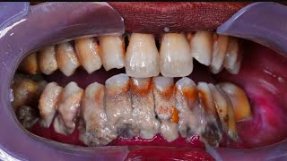 ScalingTeeth Cleaning  Should you get it done [upl. by Ahsimaj]