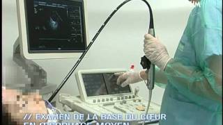 Echographie TransOesophagienne ETO  Film de formation [upl. by Aleahc798]