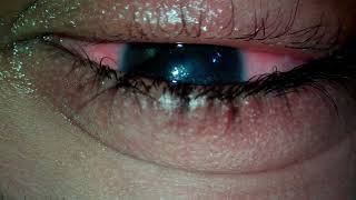 PUNCTAL PLUG FOR SEVERE DRY EYES [upl. by Jedediah]