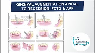 FREE CONNECTIVE TISSUE GRAFTS amp APICALLY POSITIONED FLAP GINGIVAL AUGMENTATION APICAL TO RECESSION [upl. by Anwahsiek]