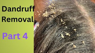 Dandruff Removal Part 4  Huge Flakes [upl. by Valencia]