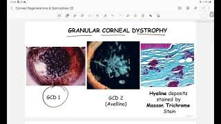 corneal dystrophies  ophthalmology  classification  clinical features  management [upl. by Asilanom279]