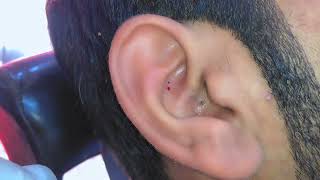 Blackheads in Ear [upl. by Beverly]