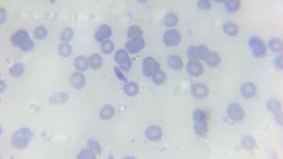 Malaria parasite plasmodium falciperum gametocyte in thick and thin blood smear in microscopic slide [upl. by Aieka]